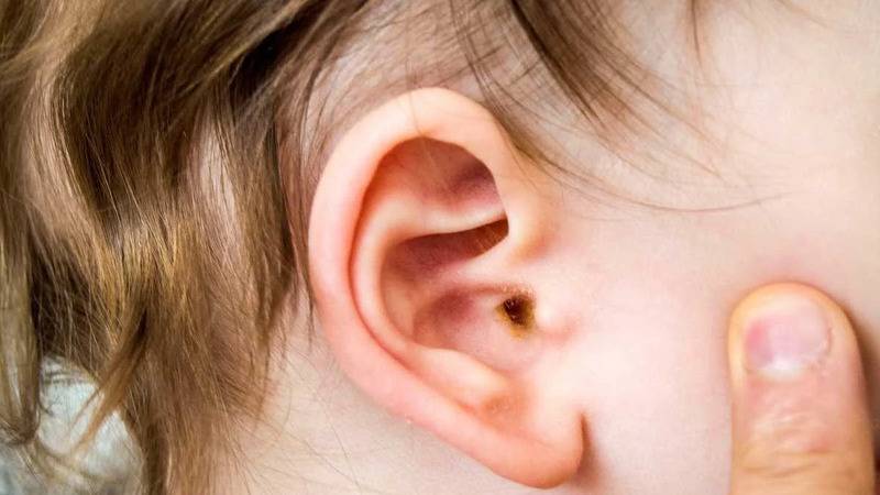 uzmani uyardi orta kulak iltihabi cocuklarda gecici isitme kaybina neden olabilir fFEJ4csu